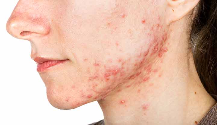 Acne breakouts