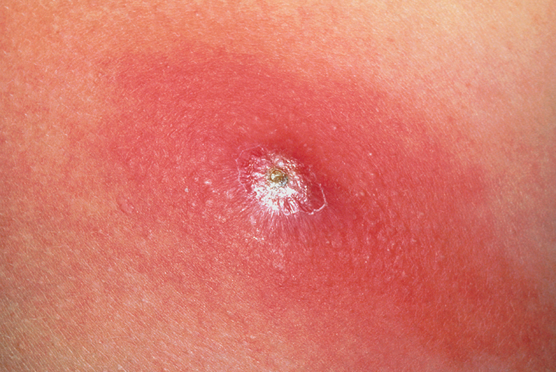 Skin infections