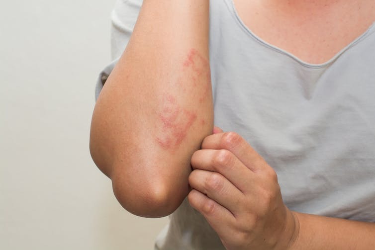 Skin irritation