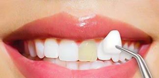 The Art of Customized Porcelain Veneers: Elevating Your Smile to Perfection Art of Customized Porcelain Veneers